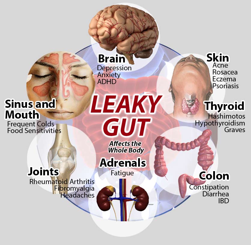 Leaky Gut Causes and Treatments