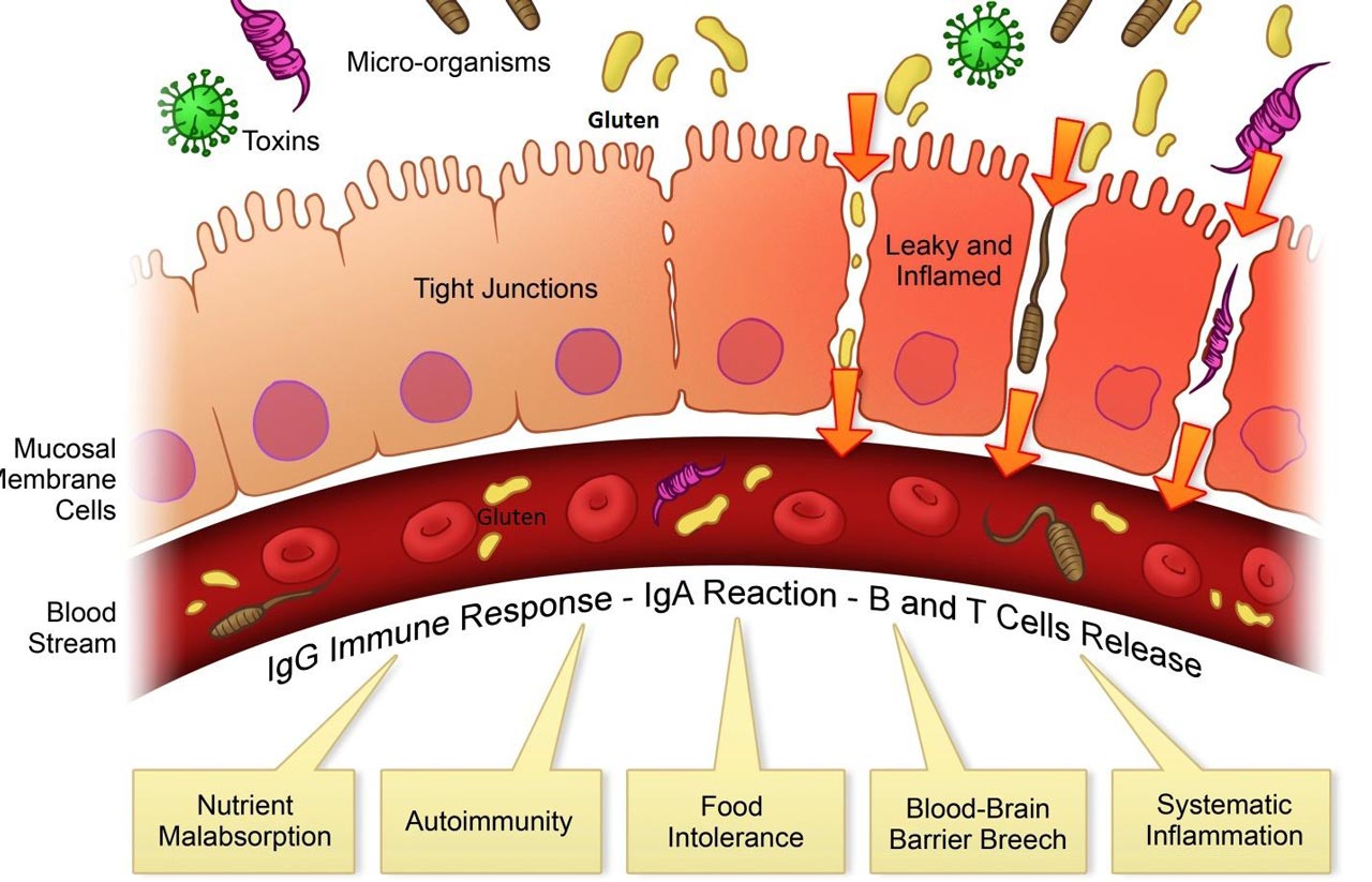 Can Leaky Gut Syndrome Cause Autoimmune Problems?